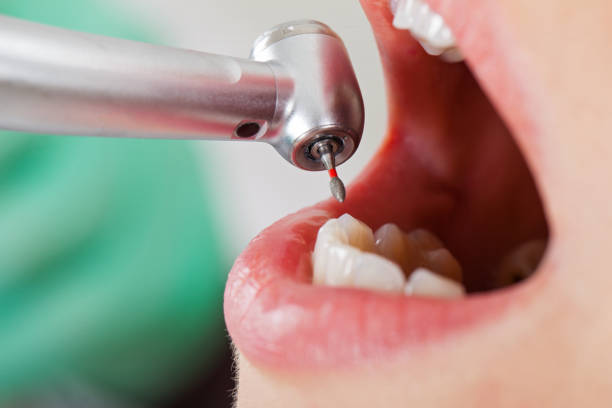 Best Emergency Wisdom Tooth Extraction in Morganville, NJ